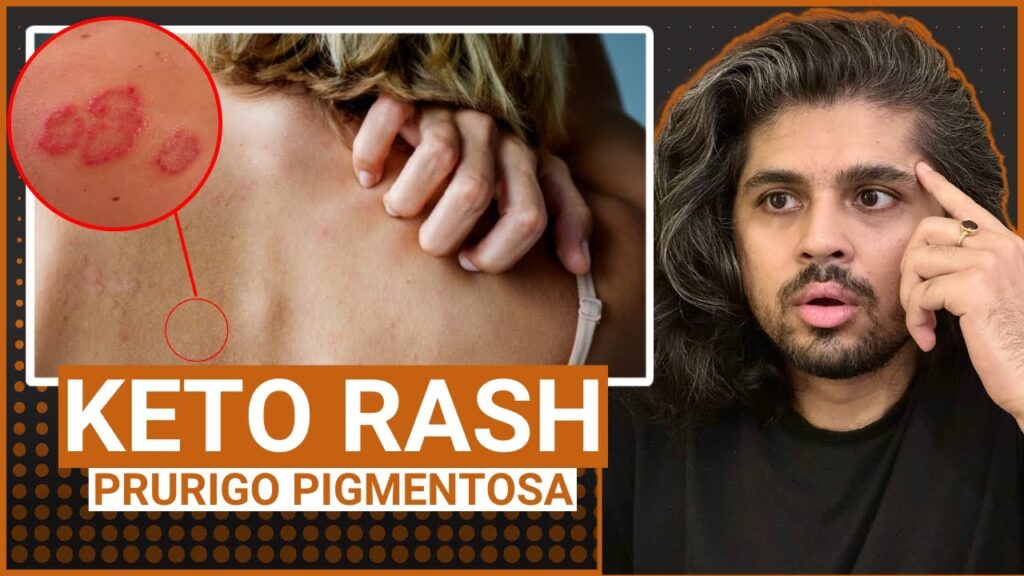 Keto rash